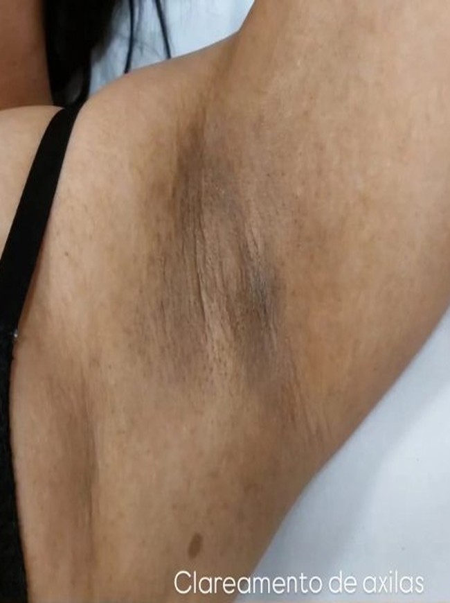 Caso real de estética íntima publicado pela Dra. Patrícia