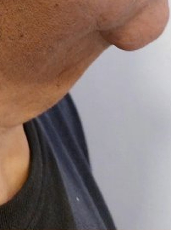 Caso real de tratamento de papada publicado pela Dra. Patrícia