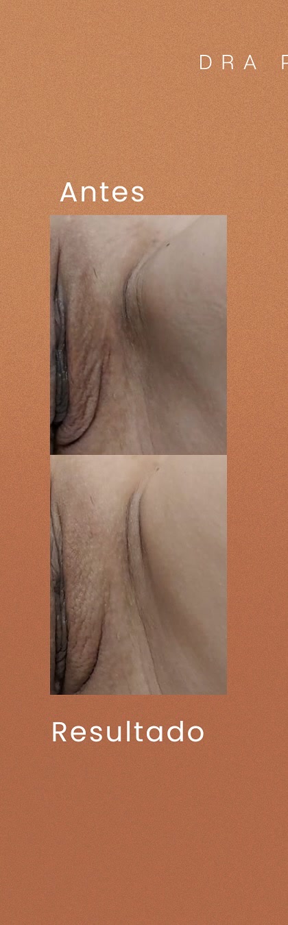 Antes e depois real de preenchimento íntimo publicado pela Dra. Patrícia Leite