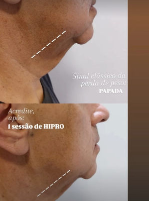 Tratamento de papada: antes e depois real publicado pela Dra. Patrícia