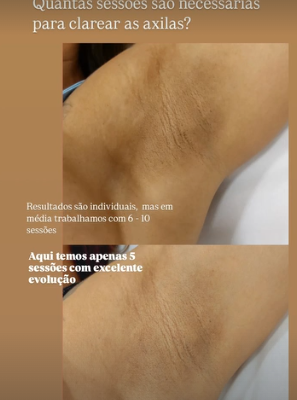 Clareamento de axilas: antes e depois real publicado pela Dra. Patrícia