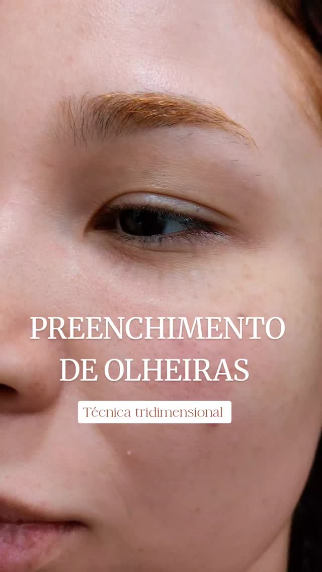 Preenchimento de olheiras: caso real publicado pela Dra. Patrícia